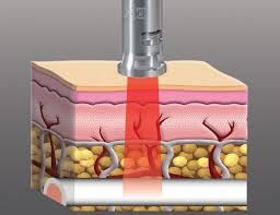 máy laser trị liệu