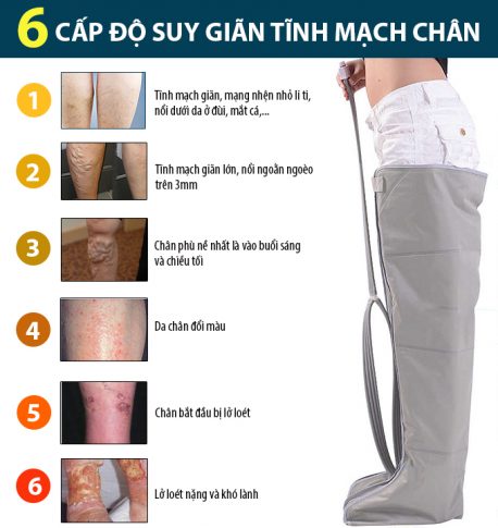 Máy nén ép trị liệu suy giãn tĩnh mạch Okachi Luxury